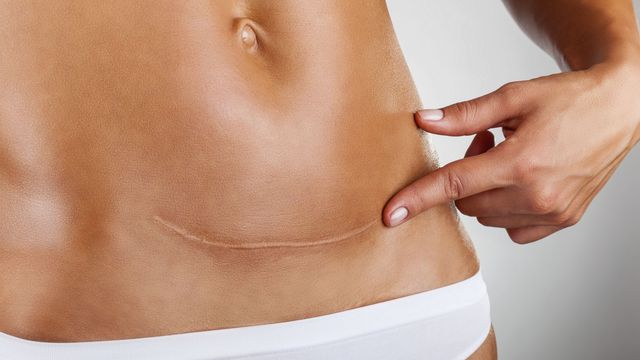 WEBBER huile vitamine E pour les cicatrices